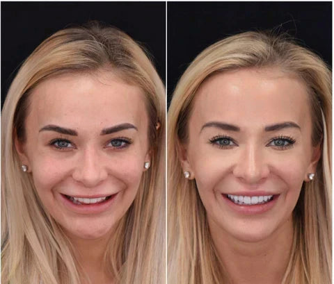 Natural-looking Instant Smile Veneers for upper & lower teeth. Get a confident, radiant smile instantly.