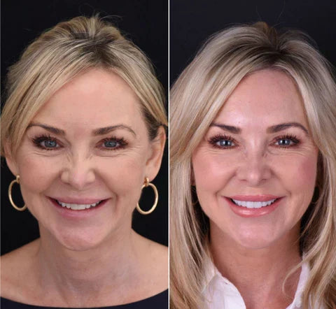 Boost your confidence with Instant Natural Smile Veneers for upper & lower teeth. Achieve a perfect smile.