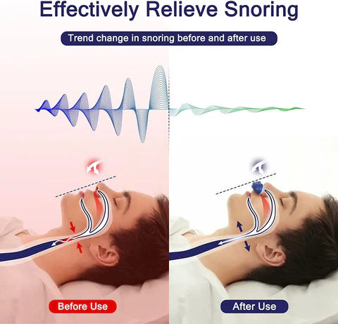 Sleek maskless nasal CPAP device for sleep apnea & snoring; a modern sleep solution.