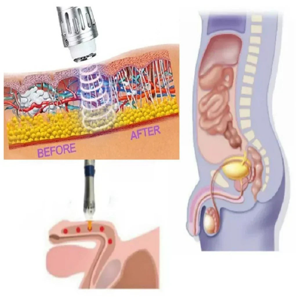 Lightweight portable shockwave device for men's ED, easy to use at home or travel.
