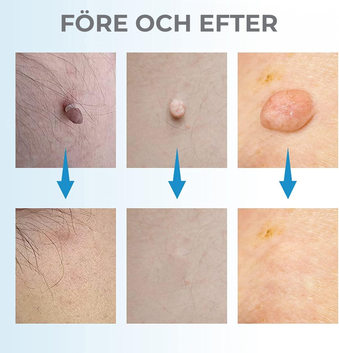 At-home cosmetic device for wart & blemish removal. Safe & effective skin tag remover beauty tool.