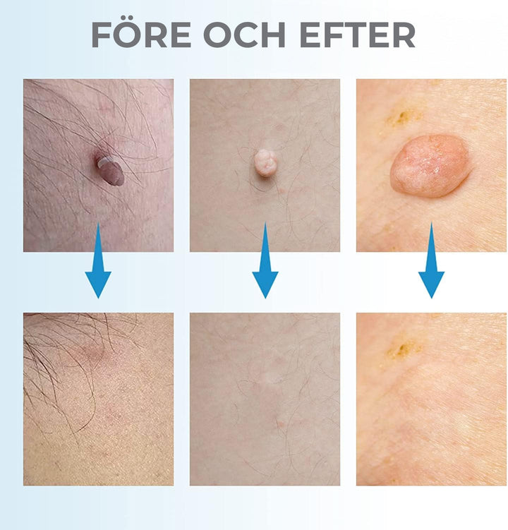 At-home cosmetic device for wart & blemish removal. Safe & effective skin tag remover beauty tool.
