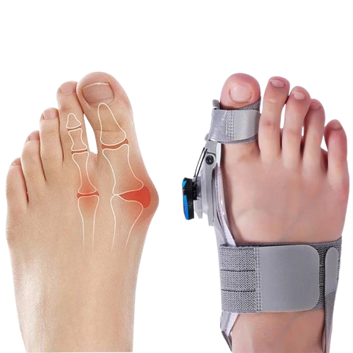 Unisex bunion corrector with toe spacer in beige silicone, featuring adjustable heel strap for foot pain relief and alignment