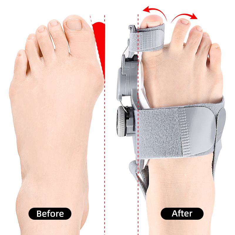 Unisex bunion corrector with toe spacer in beige silicone, featuring adjustable heel strap for foot pain relief and alignment