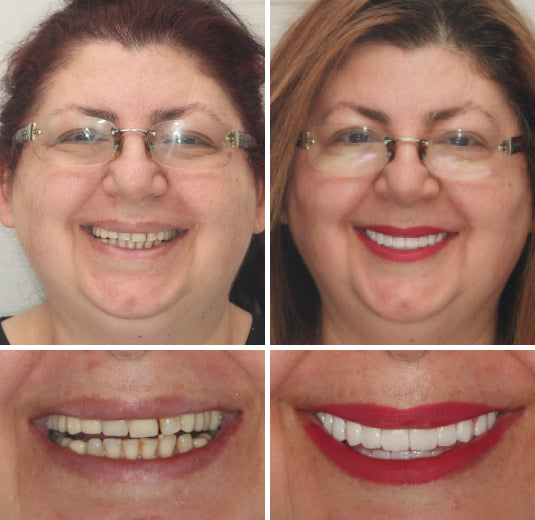 Custom-fit unisex full dentures, natural ivory white teeth, for superior comfort & a confident natural smile.